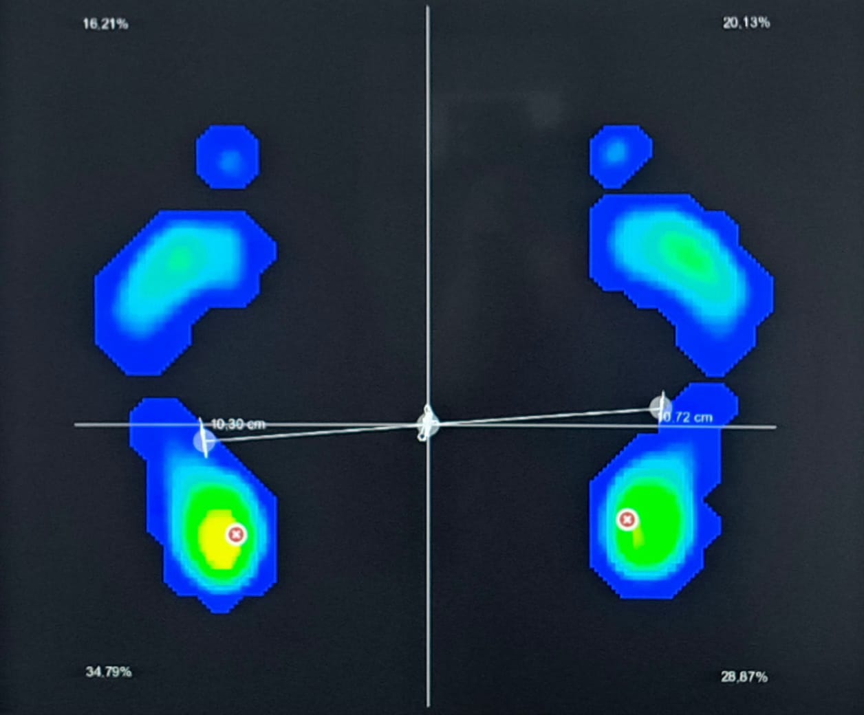 The Geometry of Roots: Precision 3D Insoles and Your Invisible Foundation